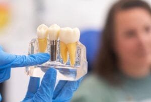 Dental Implant vs Bridge