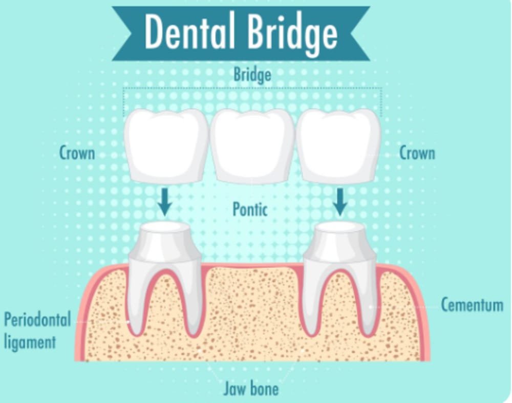 Parts of dental bridge for missing teeth