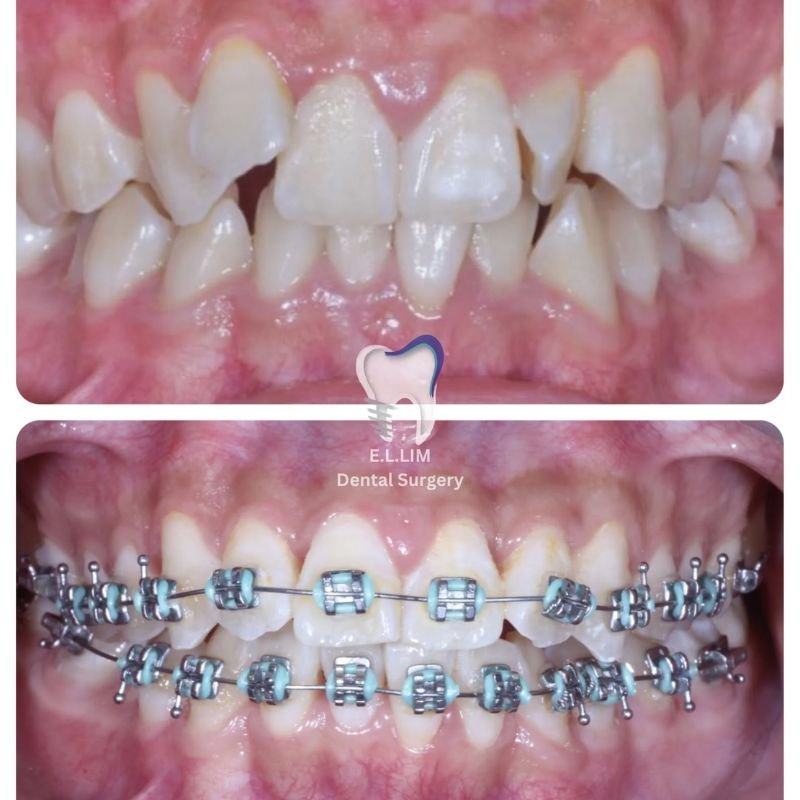 Braces treatment for crowded teeth in Sri Petaling