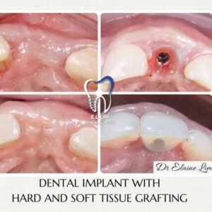 Missing tooth replacement with dental implant and tissue grafting