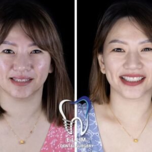Teeth whitening treatment for dull tooth shade