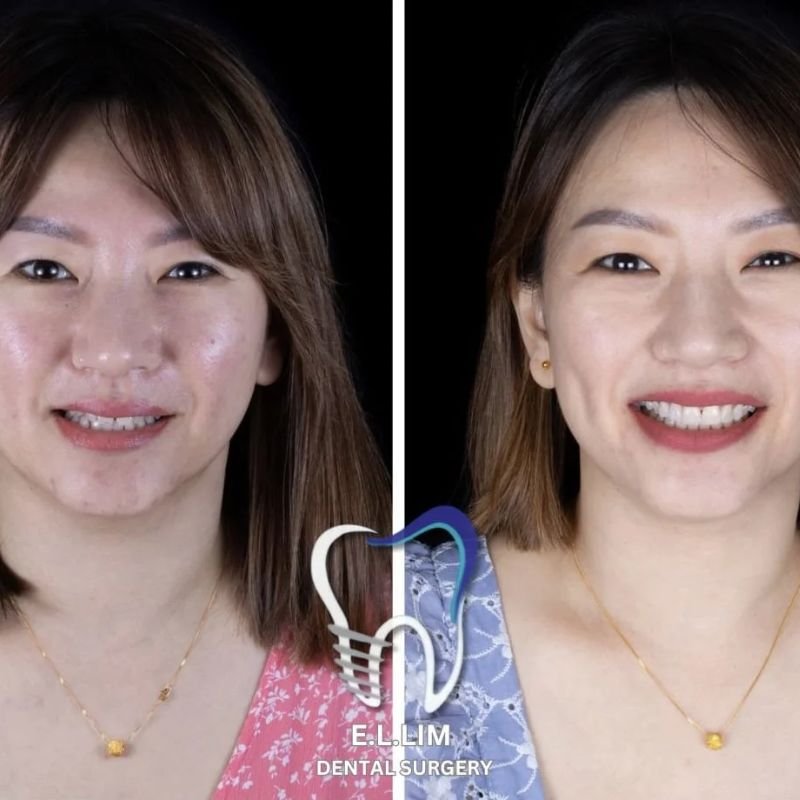 Teeth whitening treatment for dull tooth shade